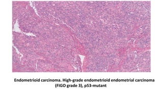 Endometrioid carcinoma. High-grade endometrioid endometrial carcinoma
(FIGO grade 3), p53-mutant
 