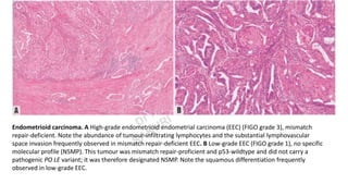 Endometrioid carcinoma. A High-grade endometrioid endometrial carcinoma (EEC) (FIGO grade 3), mismatch
repair-deficient. Note the abundance of tumour-infiltrating lymphocytes and the substantial lymphovascular
space invasion frequently observed in mismatch repair-deficient EEC. B Low-grade EEC (FIGO grade 1), no specific
molecular profile (NSMP). This tumour was mismatch repair-proficient and p53-wildtype and did not carry a
pathogenic PO LE variant; it was therefore designated NSMP. Note the squamous differentiation frequently
observed in low-grade EEC.
 