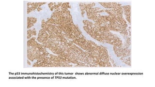 The p53 immunohistochemistry of this tumor shows abnormal diffuse nuclear overexpression
associated with the presence of TP53 mutation.
 