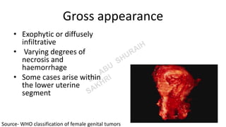 Gross appearance
• Exophytic or diffusely
infiltrative
• Varying degrees of
necrosis and
haemorrhage
• Some cases arise within
the lower uterine
segment
Source- WHO classification of female genital tumors
 