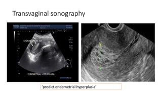 Transvaginal sonography
‘predict endometrial hyperplasia’
 