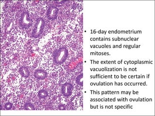 • 16-day endometrium
contains subnuclear
vacuoles and regular
mitoses.
• The extent of cytoplasmic
vacuolization is not
sufficient to be certain if
ovulation has occurred.
• This pattern may be
associated with ovulation
but is not specificaj
 