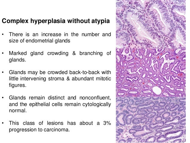 Complex Endometrial Hyperplasia With Atypia Treated
