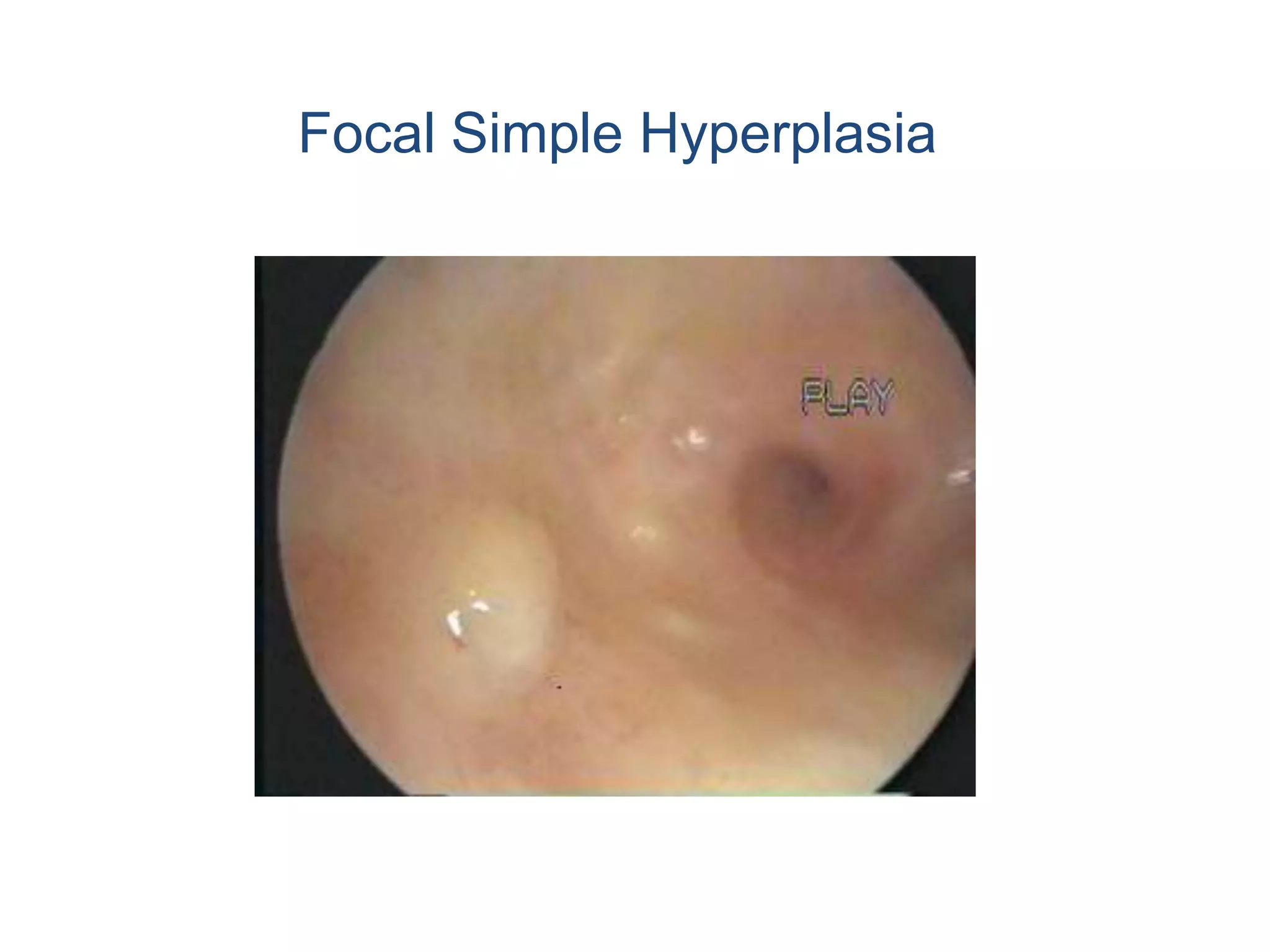 Dilation and curettage (D&C)