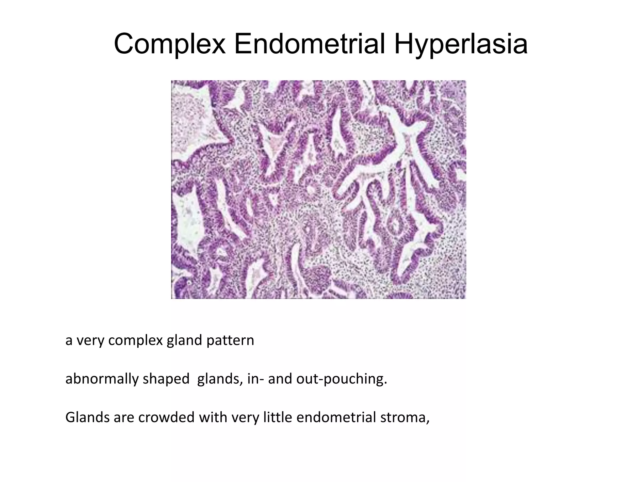Complex Endometrial Hyperlasiaa very complex gland patternabnormally shaped  glands, in- and out-pouching.Glands are crowded with very little endometrial stroma,