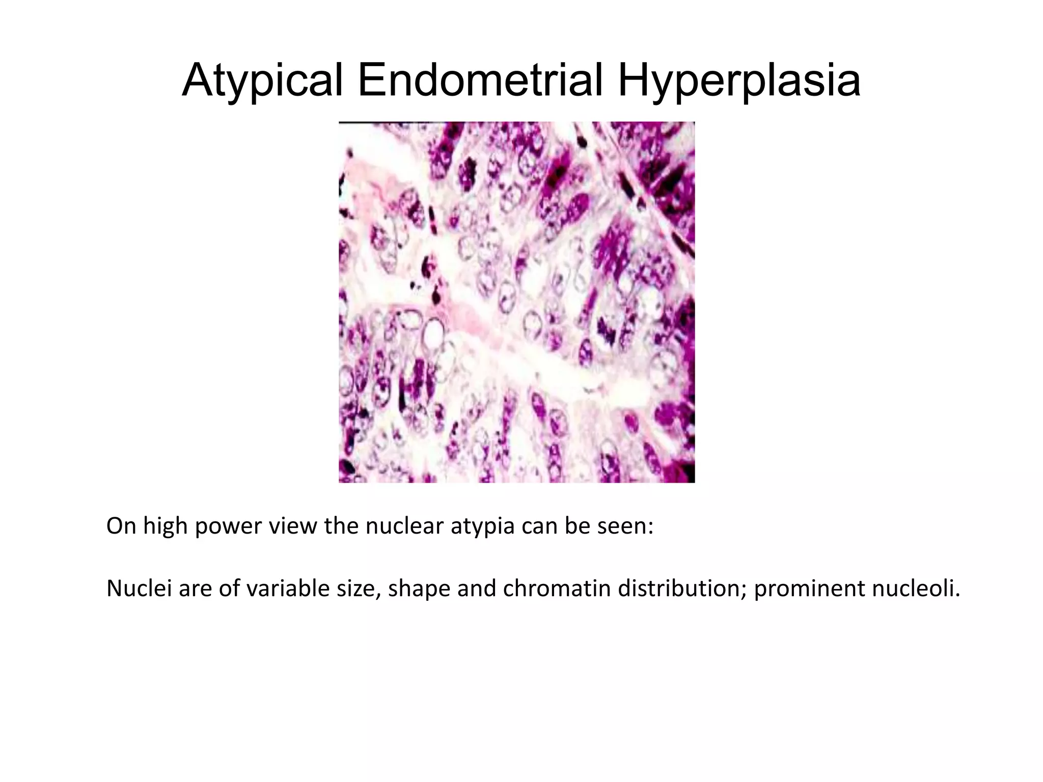 Atypical Endometrial HyperplasiaOn high power view the nuclear atypia can be seen:Nuclei are of variable size, shape and chromatin distribution; prominent nucleoli.