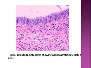Tubal (ciliated) metaplasia showing pseudostratified ciliated
cells.
 
