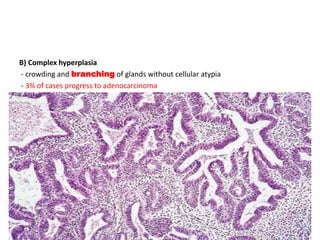 B) Complex hyperplasia
- crowding and branching of glands without cellular atypia
- 3% of cases progress to adenocarcinoma
 