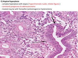 C) Atypical hyperplasia
- complex hyperplasia with atypia ( hyperchromatic nuclei, mitotic figures )
- commonly progresses to adenocarcinoma
- treated may be with Tamoxifen (antiestrogen) or hysterectomy
 