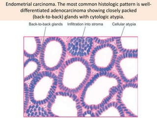 Endometrial carcinoma. The most common histologic pattern is well-
differentiated adenocarcinoma showing closely packed
(back-to-back) glands with cytologic atypia.
 