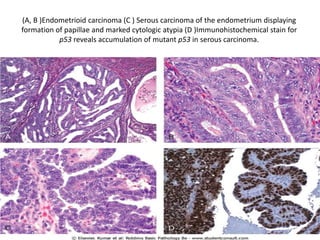 (A, B )Endometrioid carcinoma (C ) Serous carcinoma of the endometrium displaying
formation of papillae and marked cytologic atypia (D )Immunohistochemical stain for
p53 reveals accumulation of mutant p53 in serous carcinoma.
 