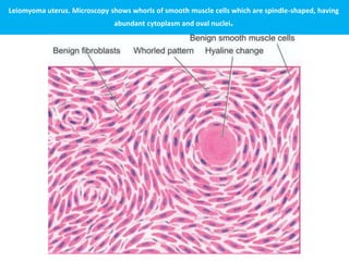 Leiomyoma uterus. Microscopy shows whorls of smooth muscle cells which are spindle-shaped, having
abundant cytoplasm and oval nuclei.
 