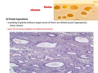 A) Simple hyperplasia
- crowding of glands without atypia some of them are dilated (cystic hyperplasia)
:Swiss cheese
- only 1% of cases progress to adenocarcinoma
Swiss
cheese
 