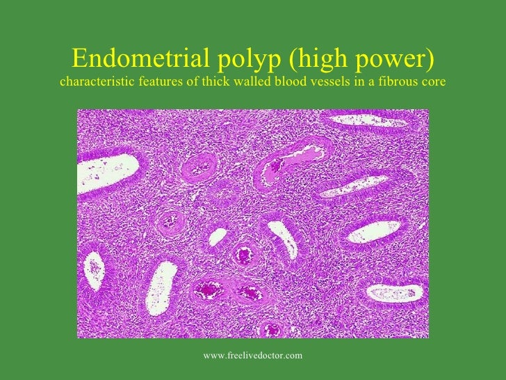 Endometrial polyps