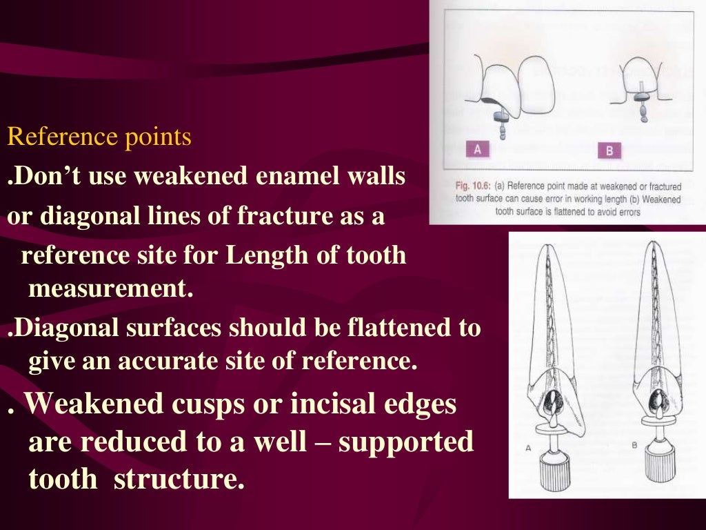working length estimation in endodontic