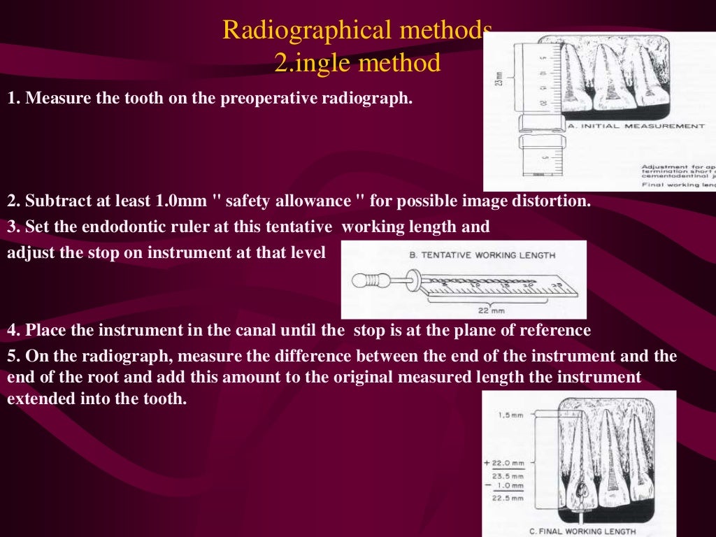 working length estimation in endodontic