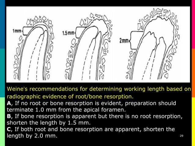 Endometrics root canal working length determination | PPT