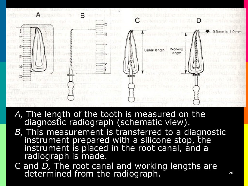 Endometrics root canal working length determination