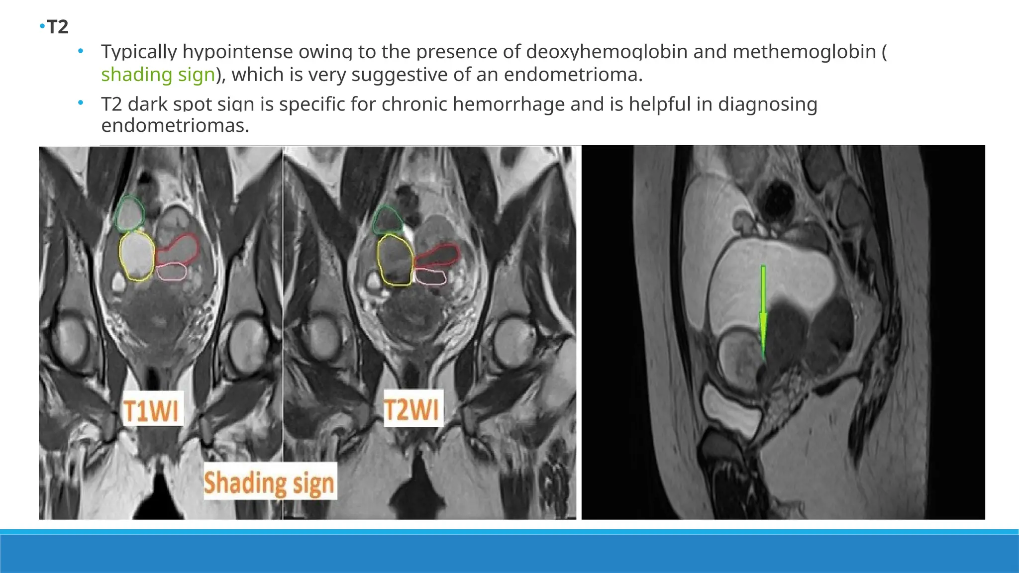 Endometrioma a brief presentation pg.pptx