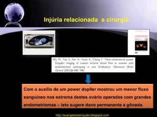 Injúria relacionada  a cirurgiaEm contraste com a mini laparotomia, o procedimento laparoscópico se caracteriza por um maior uso de energia  para conseguir uma boa hemostasia, levando a um dano ainda maior aos folículos primordiais.http://evangelistatorquato.blogspot.com24