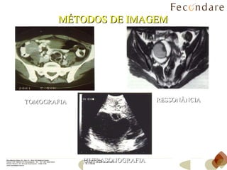 MÉTODOS DE IMAGEM TOMOGRAFIA RESSONÂNCIA ULTRASONOGRAFIA 
