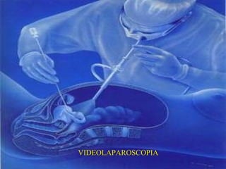 VIDEOLAPAROSCOPIA 