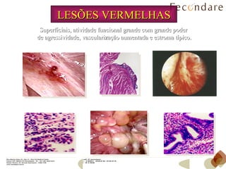 LESÕES VERMELHAS Superficiais, atividade funcional grande com grande poder  de agressividade, vascularização aumentada e estroma típico. 