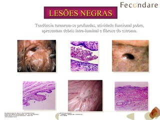 LESÕES NEGRAS Tendência tornarem-se profundas, atividade funcional pobre, apresentam debris intra-luminal e fibrose do estroma. 