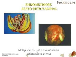 ENDOMETRIOSE  SEPTO RET0-VAGINAL Metaplasia de restos embrionários  Adenomiose externa 
