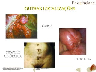 OUTRAS LOCALIZAÇÕES BEXIGA INTESTINO CICATRIZ CIRÚRGICA 