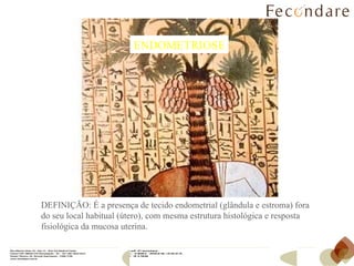 DEFINIÇÃO: Endométrio (glândula e estroma) - um tecido com estrutura histológica e resposta fisiológica da mucosa uterina - fora do seu local habitual (útero). ENDOMETRIOSE DEFINIÇÃO: É a presença de tecido endometrial (glândula e estroma) fora do seu local habitual (útero), com mesma estrutura histológica e resposta fisiológica da mucosa uterina. 