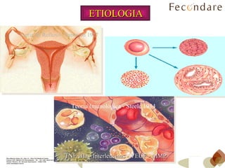 ETIOLOGIA Teoria do Refluxo - Sampson 1927 Teoria da Metaplasia Celômica - Meyer 1919 Teoria Imunológica - Steele 1984 TNF alfa - Interleucinas - VEGF - MMP 