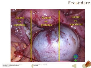 Lateral ou  superficial Lateral ou  superficial Central ou  profunda 