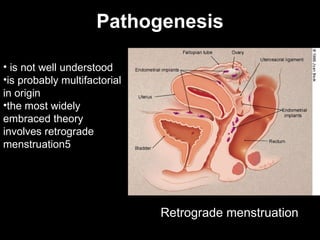 Pathogenesis is not well understood is probably multifactorial in origin the most widely embraced theory involves retrograde menstruation 5 Retrograde menstruation 