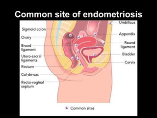 Common site of endometriosis 