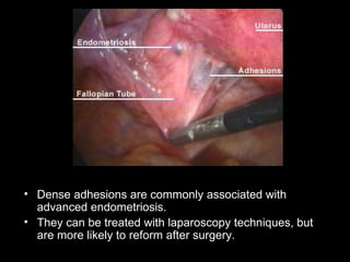 Dense adhesions are commonly associated with advanced endometriosis.  They can be treated with laparoscopy techniques, but are more likely to reform after surgery.  