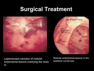Surgical Treatment   Laparoscopic excision of nodular endometrial lesions overlying the rectum  Nodular endometrial lesions in the posterior cul-de-sac.  