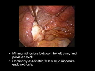 Minimal adhesions between the left ovary and pelvic sidewall.  Commonly associated with mild to moderate endometriosis.  