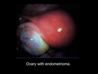 Ovary with endometrioma.  