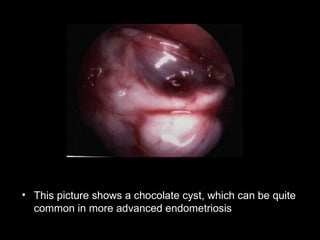 This picture shows a chocolate cyst, which can be quite common in more advanced endometriosis   