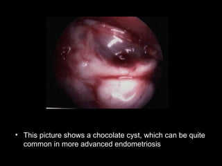 <ul><li>This picture shows a chocolate cyst, which can be quite common in more advanced endometriosis   </li></ul>