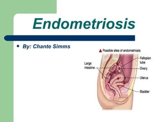 Endometriosis
   By: Chante Simms
 