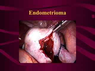 Endometrioma
 