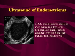 Ultrasound of Endometrioma

           on US, endometriomas appear as
           cysts that contain low-level
           homogeneous internal echoes
           consistent with old blood (ddx
           includes hemorrhagic cysts)
 