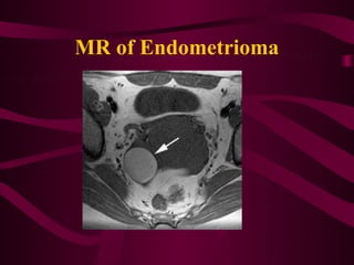 MR of Endometrioma
 