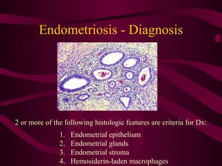Endometriosis - Diagnosis




2 or more of the following histologic features are criteria for Dx:
               1.   Endometrial epithelium
               2.   Endometrial glands
               3.   Endometrial stroma
               4.   Hemosiderin-laden macrophages
 
