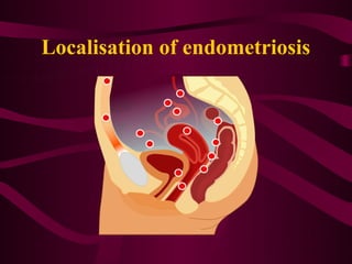 Localisation of endometriosis
 