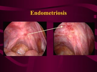 Endometriosis
 