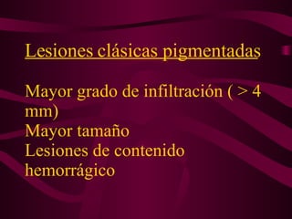 Lesiones clásicas pigmentadas   Mayor grado de infiltración ( > 4 mm)  Mayor tamaño  Lesiones de contenido hemorrágico 