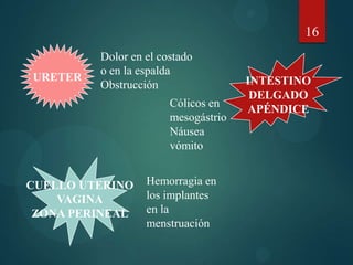 URETER
Dolor en el costado
o en la espalda
Obstrucción INTESTINO
DELGADO
APÉNDICE
Cólicos en
mesogástrio
Náusea
vómito
CUELLO UTERINO
VAGINA
ZONA PERINEAL
Hemorragia en
los implantes
en la
menstruación
16
 